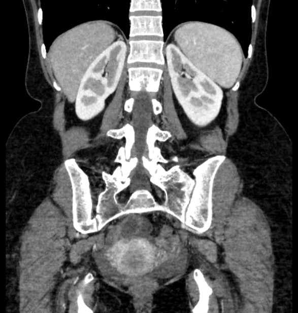 Closed loop small bowel obstruction (Radiopaedia 71211-81508 B 95).jpg