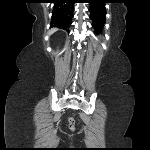 Closed loop small bowel obstruction - internal hernia (Radiopaedia 65402-74450 B 90).jpg