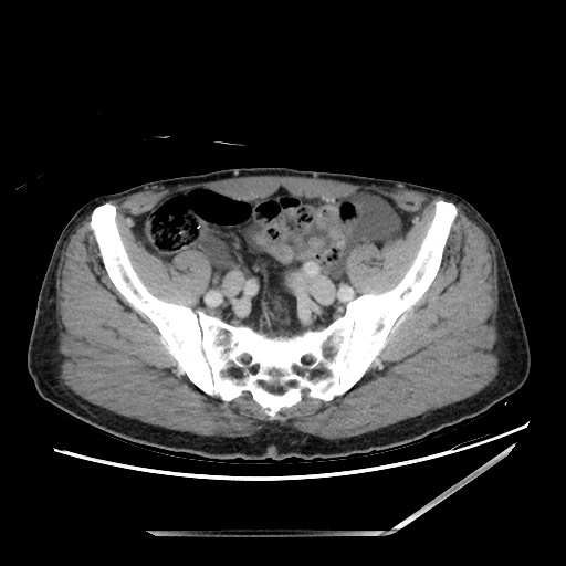 Closed loop small bowel obstruction - omental adhesion causing "internal hernia" (Radiopaedia 85129-100682 A 132).jpg