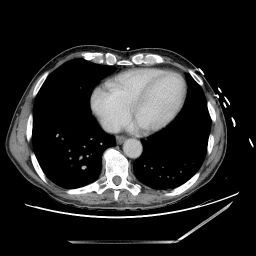 Closed loop small bowel obstruction - omental adhesion causing "internal hernia" (Radiopaedia 85129-100682 A 3).jpg
