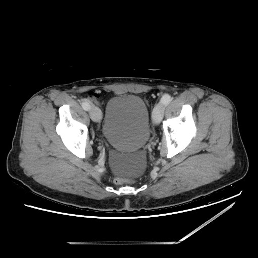 File:Closed loop small bowel obstruction - omental adhesion causing "internal hernia" (Radiopaedia 85129-100682 Axial 104).jpg