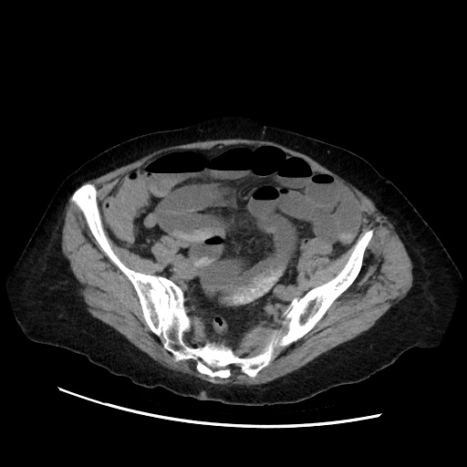 Closed loop small bowel obstruction due to adhesive band, with intramural hemorrhage and ischemia (Radiopaedia 83831-99017 Axial non-contrast 121).jpg