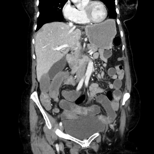 Closed loop small bowel obstruction due to adhesive band, with intramural hemorrhage and ischemia (Radiopaedia 83831-99017 C 53).jpg