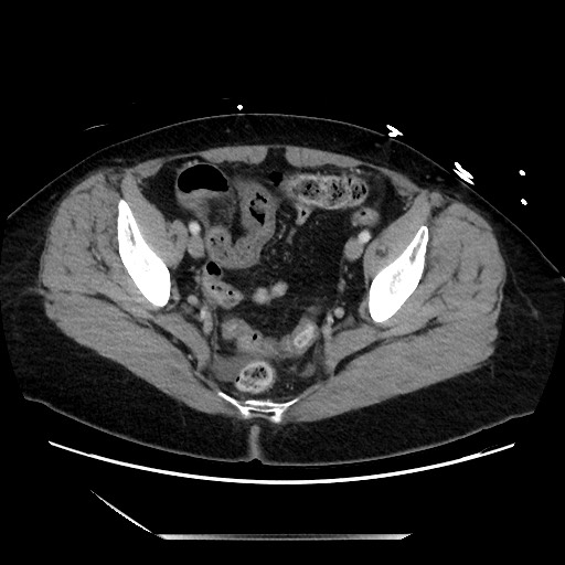 Closed loop small bowel obstruction due to adhesive bands - early and late images (Radiopaedia 83830-99014 A 130).jpg