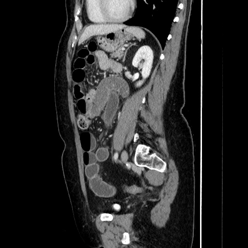 Closed loop small bowel obstruction due to adhesive bands - early and late images (Radiopaedia 83830-99015 C 114).jpg
