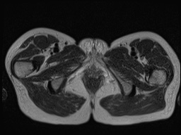File:Closed loop small bowel obstruction in pregnancy (MRI) (Radiopaedia 87637-104031 D 46).jpg