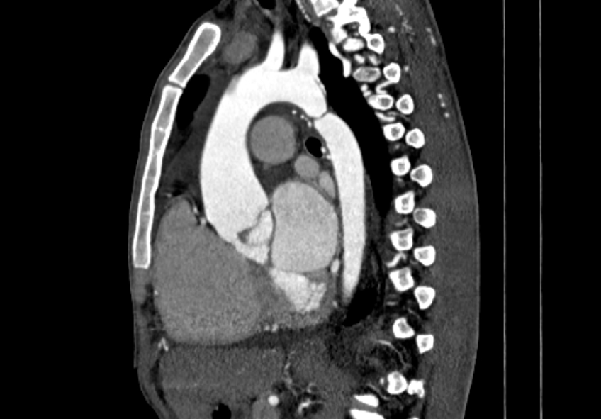 Coarctation of aorta with aortic valve stenosis (Radiopaedia 70463-80574 B 77).jpg
