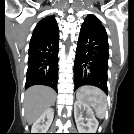 File:Coarctation of the aorta (Radiopaedia 67609-77010 B 19).jpg