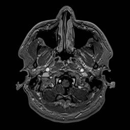 File:Cochlear incomplete partition type III associated with hypothalamic hamartoma (Radiopaedia 88756-105498 Axial T1 C+ 35).jpg