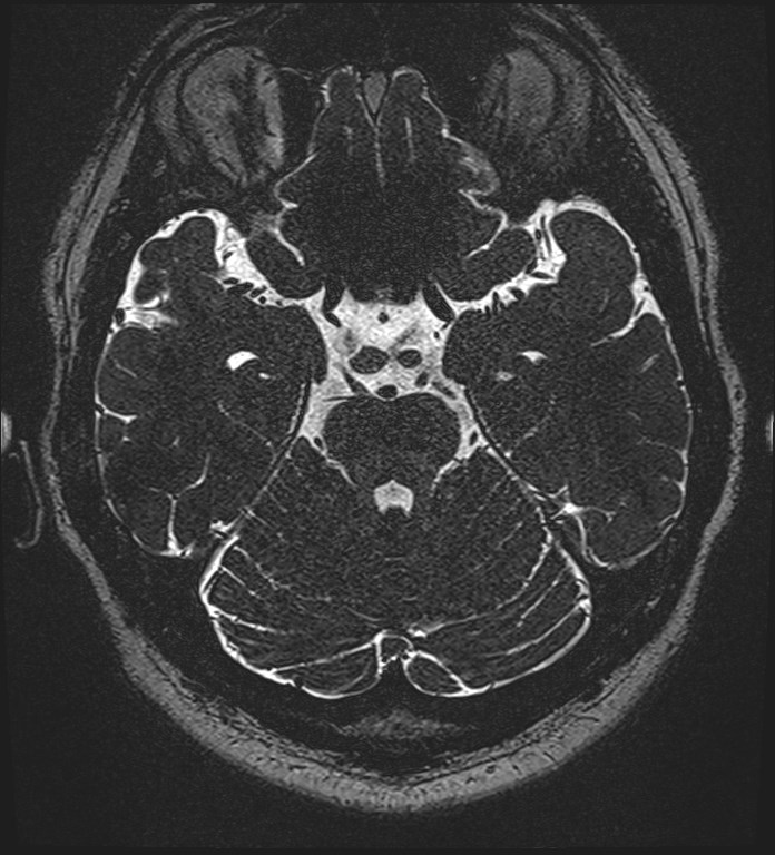 Cochlear incomplete partition type III associated with hypothalamic hamartoma (Radiopaedia 88756-105498 Axial T2 124).jpg