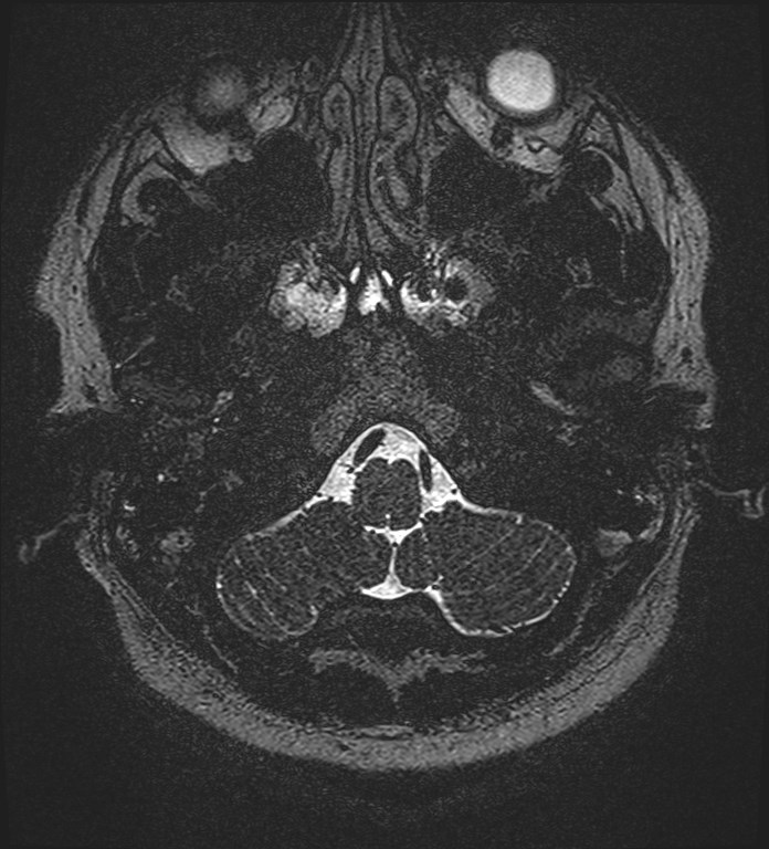 Cochlear incomplete partition type III associated with hypothalamic hamartoma (Radiopaedia 88756-105498 Axial T2 23).jpg