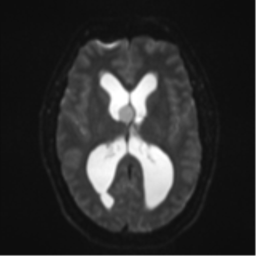 File:Colloid cyst (Radiopaedia 53164-59125 Axial DWI 15).png