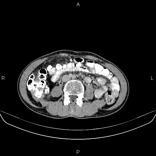File:Colon adenocarcinoma - hepatic flexure (Radiopaedia 85635-101395 Axial C+ delayed 50).jpg