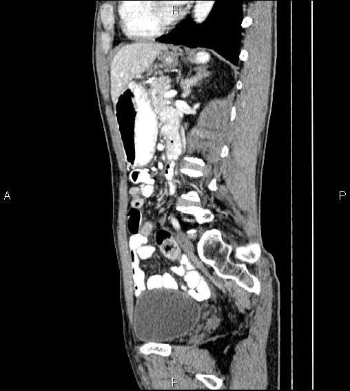 File:Colon adenocarcinoma - hepatic flexure (Radiopaedia 85635-101395 D 55).jpg