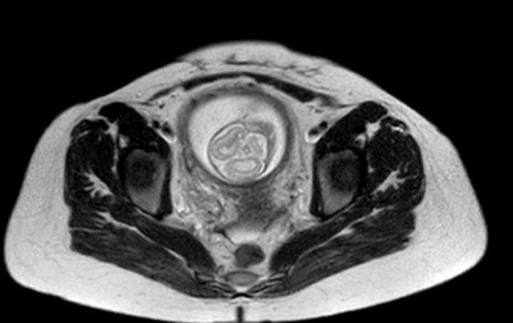 Colon adenocarcinoma with Krukenberg tumors, advanced pregnancy (Radiopaedia 67279-76645 Axial T2 12).jpg