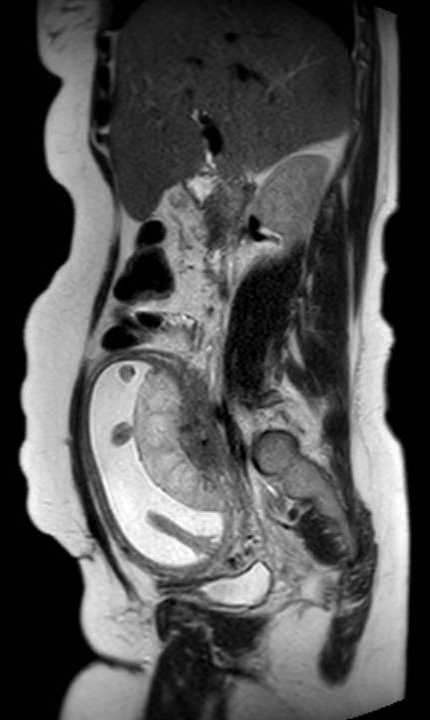 Colon adenocarcinoma with Krukenberg tumors, advanced pregnancy (Radiopaedia 67279-76645 Sagittal T2 32).jpg