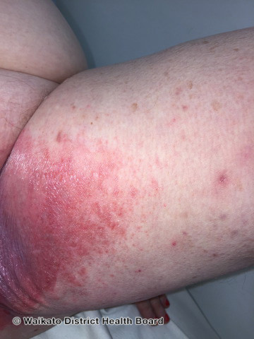 File:Contact irritant dermatitis due to urine. Napkin dermatitis in adult. (DermNet NZ dermatitis-w-napkin-dermatitis37).jpg