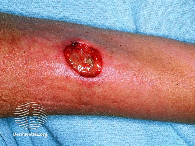File:Eosinophilic granulomatosis with polyangiitis (DermNet NZ systemic-css2).jpg