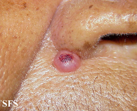 File:Keratoacanthoma (Dermatology Atlas 14).jpg