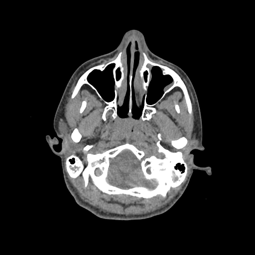 Nasal pyogenic granuloma (lobular capillary hemangioma) (Radiopaedia 85536-101244 Axial non-contrast 48).jpg