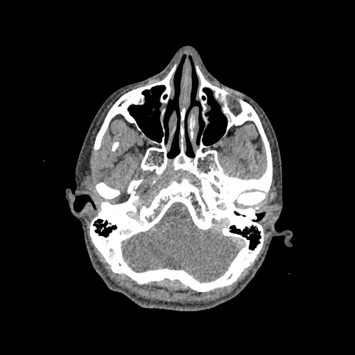 File:Nasal pyogenic granuloma (lobular capillary hemangioma) (Radiopaedia 85536-101244 C 74).jpg