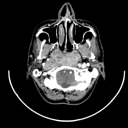 Nasopharyngeal carcinoma - infiltrating the clivus (Radiopaedia 62583-70875 Axial Post contrast 17).jpg