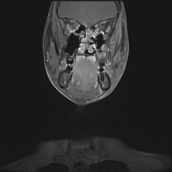 Nasopharyngeal carcinoma with skull base invasion (Radiopaedia 53415-59485 E 30).jpg