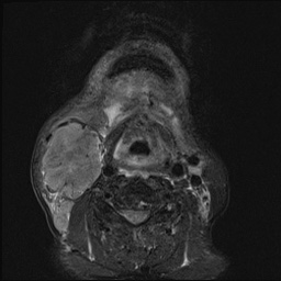File:Nasopharyngeal carcinoma with skull base invasion (Radiopaedia 59258-66600 D 49).jpg