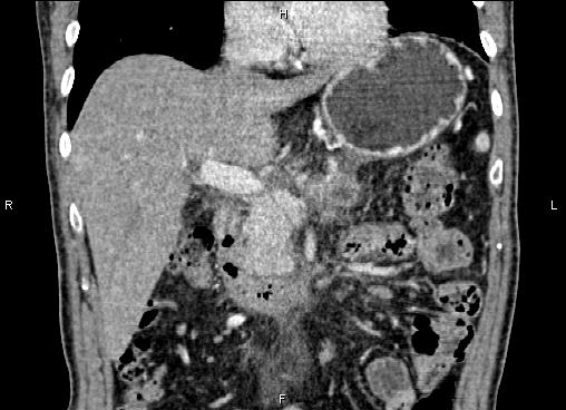Necrotizing pancreatitis (Radiopaedia 87796-104248 F 27).jpg