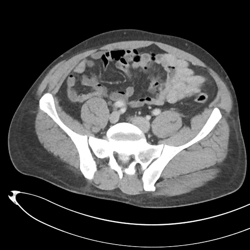 File:Necrotizing pancreatitis with acute necrotic collections (Radiopaedia 38829-41012 B 60).png