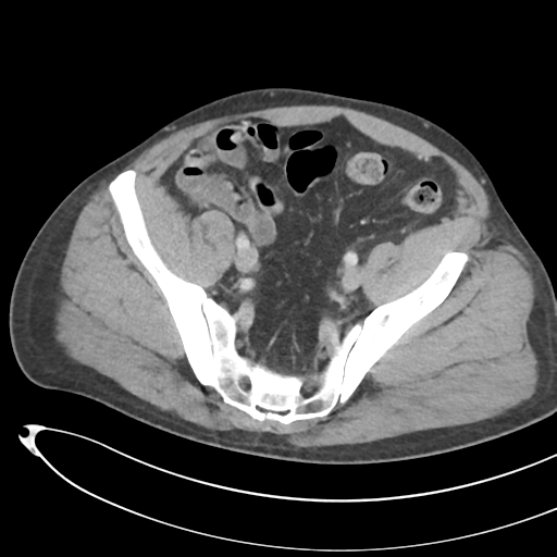 File:Necrotizing pancreatitis with acute necrotic collections (Radiopaedia 38829-41012 B 67).png