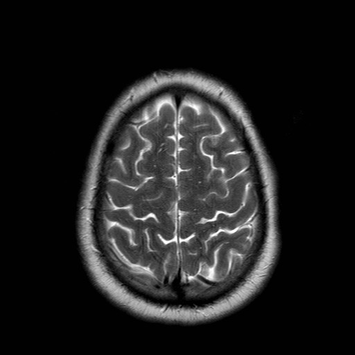 File:Neuro-Behcet's disease (Radiopaedia 21557-21505 Axial T2 19).jpg