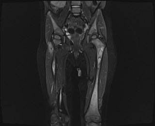 File:Neuroblastoma with bone metastases (Radiopaedia 67080-76414 Coronal STIR 12).jpg