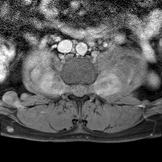 File:Neurofibromatosis type 1- extensive spinal involvement and Christmas tree sign (Radiopaedia 60610-68332 Axial T1 C+ fat sat 65).jpg