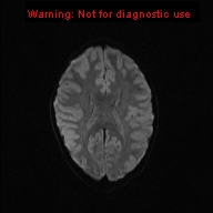 File:Neurofibromatosis type 1 with optic nerve glioma (Radiopaedia 16288-15965 Axial DWI 33).jpg