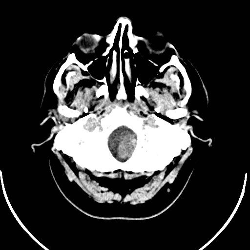 Neurofibromatosis type 2 (Radiopaedia 79097-92047 Axial non-contrast 6).jpg