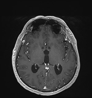Neurofibromatosis type 2 (Radiopaedia 79097-92049 Axial T1 C+ 103).jpg