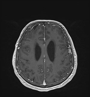 Neurofibromatosis type 2 (Radiopaedia 79097-92049 Axial T1 C+ 140).jpg