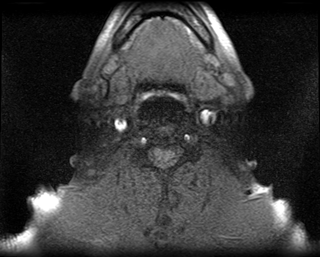 File:Non-Hodgkin lymphoma - parotid gland (Radiopaedia 71531-81890 T1 fat sat 5).jpg