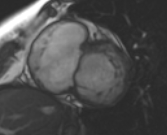 File:Non-compaction of the left ventricle (Radiopaedia 69436-79314 Short axis cine 179).jpg