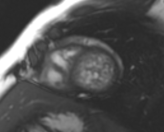 File:Non-compaction of the left ventricle (Radiopaedia 69436-79314 Short axis cine 70).jpg