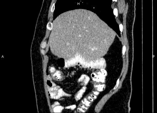 Non-syndromic pancreatic endocrine tumor (Radiopaedia 86958-103178 E 16).jpg
