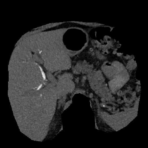 File:Normal CT intravenous cholangiogram (Radiopaedia 38199-40208 Axial IVC (MIP) 56).png