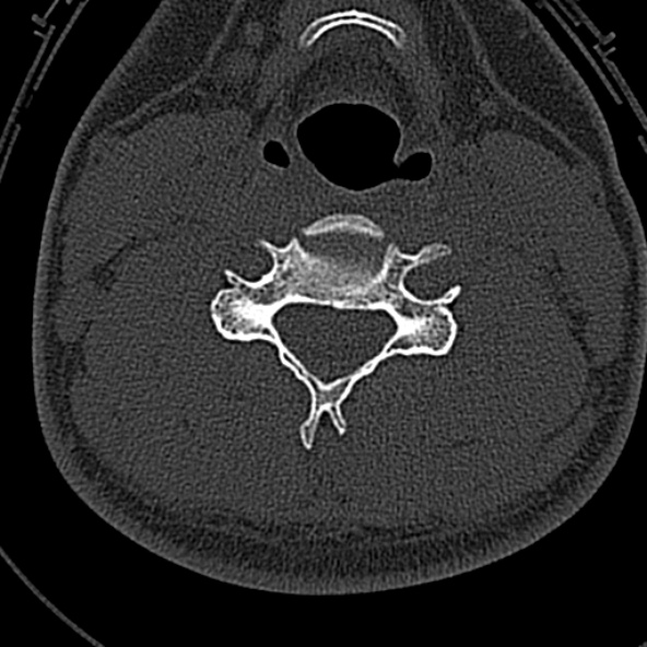 File:Normal CT of the cervical spine (Radiopaedia 53322-59305 Axial bone window 153).jpg
