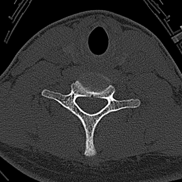Normal CT of the cervical spine (Radiopaedia 53322-59305 Axial bone window 200).jpg
