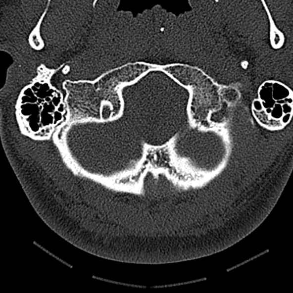 Normal CT of the cervical spine (Radiopaedia 53322-59305 Axial bone window 38).jpg