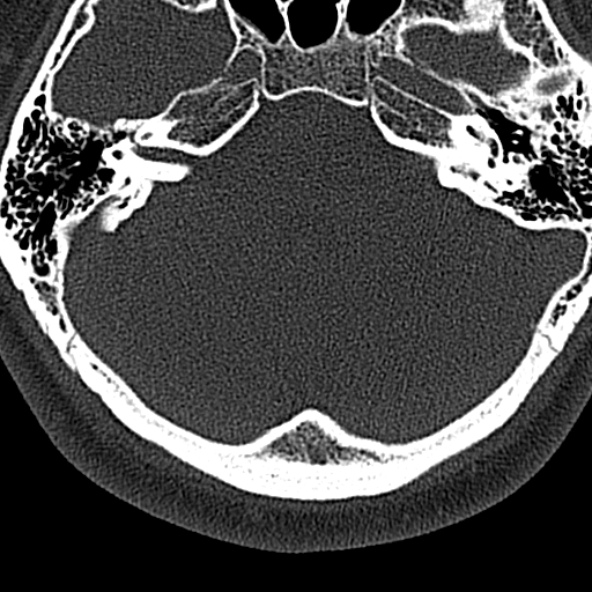 Normal CT of the cervical spine (Radiopaedia 53322-59305 Axial bone window 4).jpg