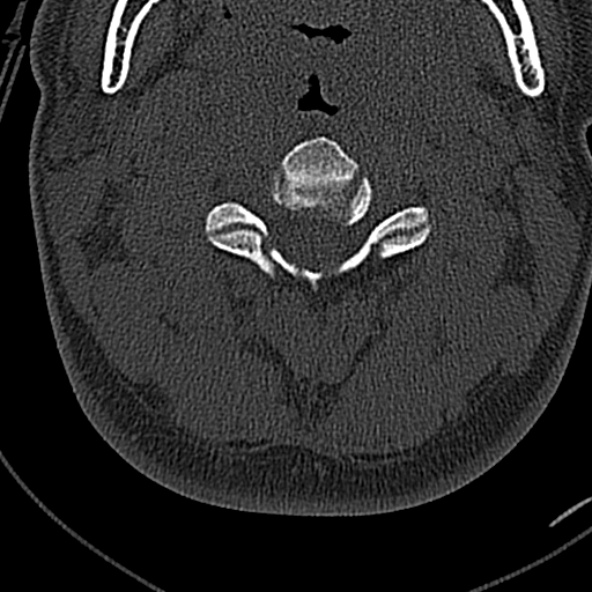 Normal CT of the cervical spine (Radiopaedia 53322-59305 Axial bone window 97).jpg