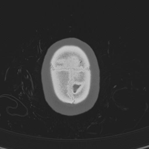 Normal CT skull (Radiopaedia 40798-43459 A 150).png