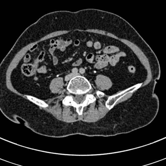 File:Normal CT split bolus study of the renal tract (Radiopaedia 48631-53634 Axial split bolus 174).jpg